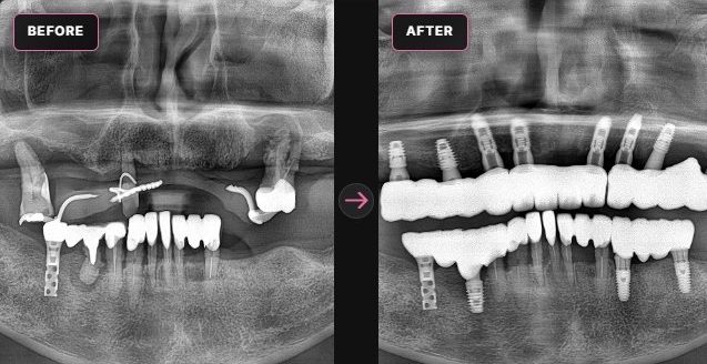 All-on-X — panoramic X-ray before and after, CERA Dental Clinic