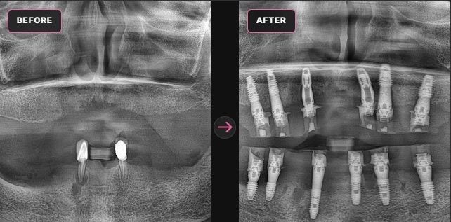 All-on-X — panoramic X-ray before and after, CERA Dental Clinic