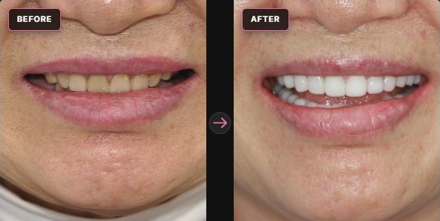 Cera-Lift — before and after, CERA Dental Clinic