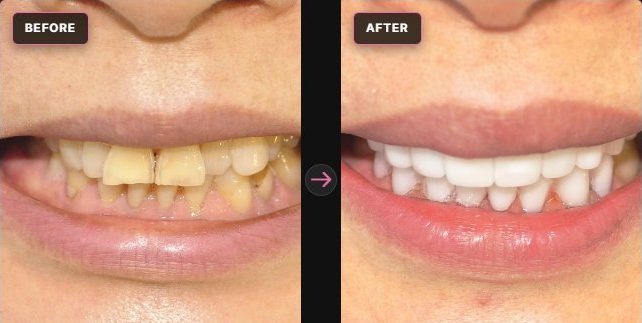 Cera-Lift — before and after, CERA Dental Clinic