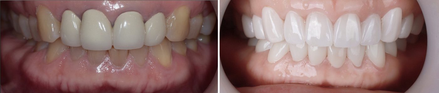 Cera-Lift on worn front teeth — before (left) and after (right), CERA Dental Clinic