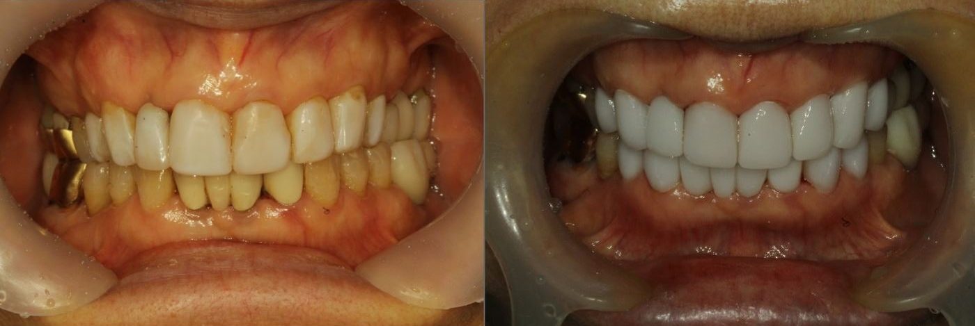 Ceramel laminates — before (left) and after (right), CERA Dental Clinic