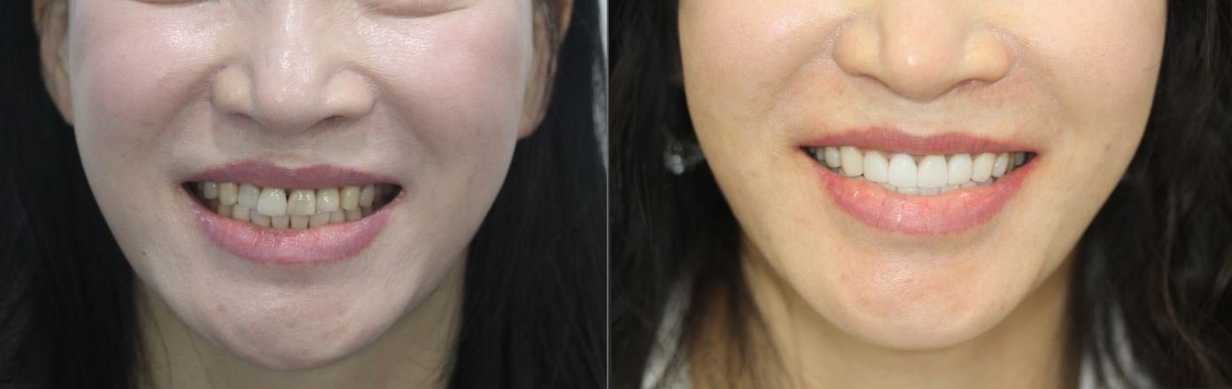 Ceramel laminates — the smile before and after, CERA Dental Clinic