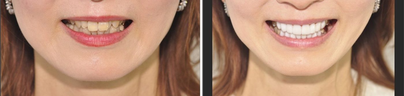Ceramel laminates — before and after, CERA Dental Clinic
