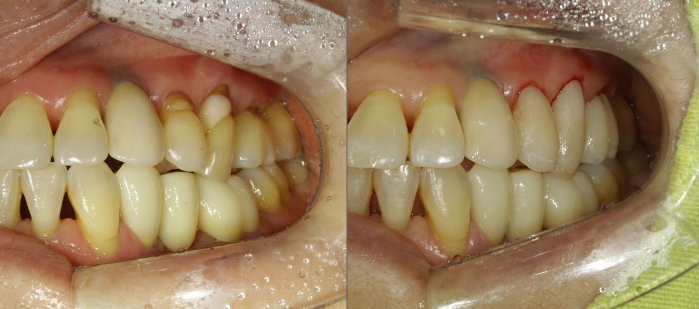 CeraShield on worn enamel at the gum line — before and after, CERA Dental Clinic