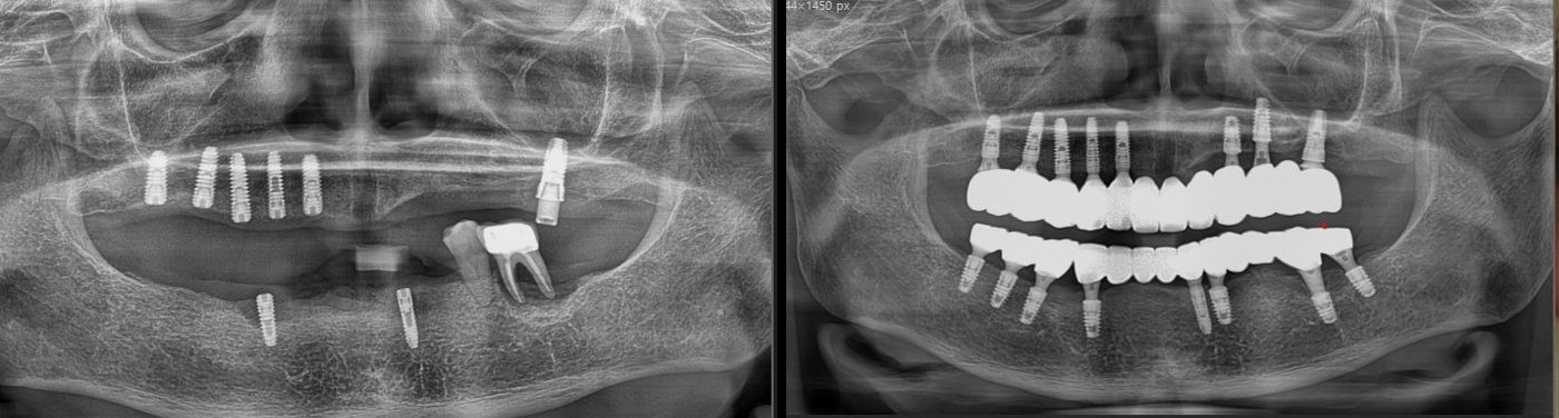 Implants in both arches — panoramic X-ray before (left) and after (right), CERA Dental Clinic
