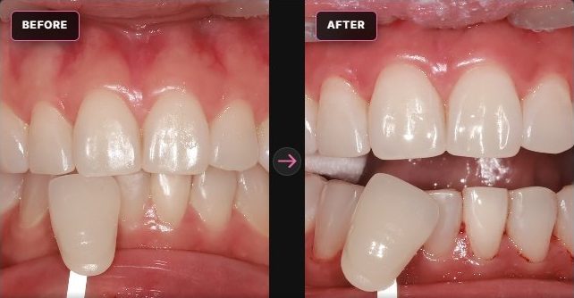 Teeth whitening — shade before and after, CERA Dental Clinic
