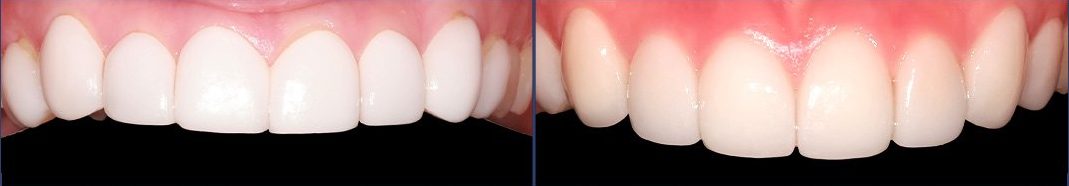 Laminates from another clinic (left) replaced with zirconia laminates (right), CERA Dental Clinic