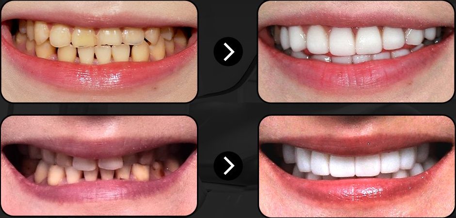 Zirconia laminates — two cases, before and after, CERA Dental Clinic